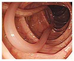 ascariasis-pictures-5.jpg