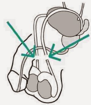 vasectomy-compressed.jpg