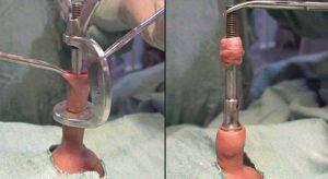 Circumcision-Procedure-300x164.jpg