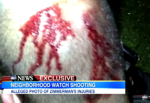george-zimmerman-bloody-head.png